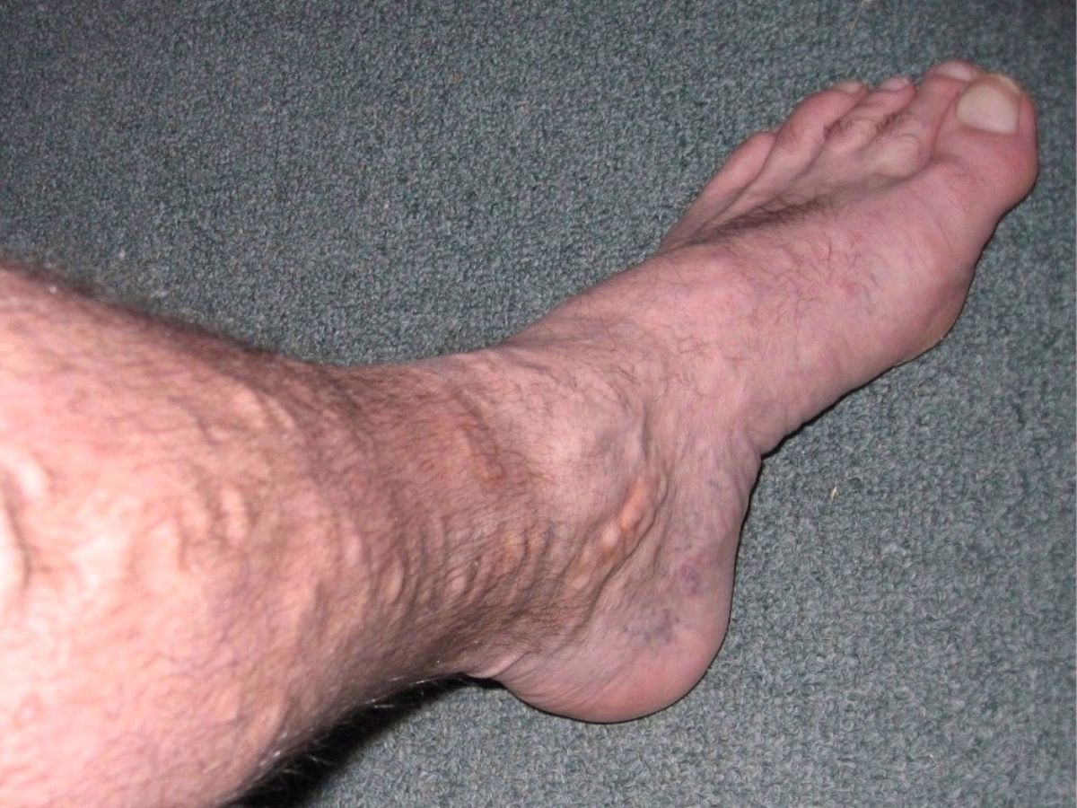 Varicose Veins: What are the Risk Factors and Treatment Options?