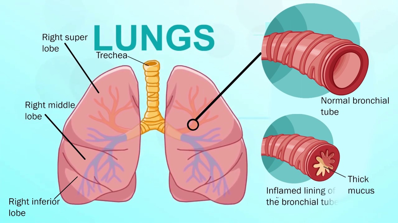 Bronchitis Symptoms, Signs, Treatment, Prevention, Diagnosis and Types