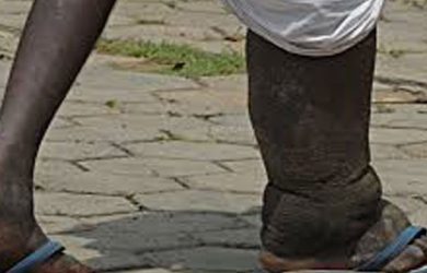 Elephantitis elephantiasis symptoms elephantiasis face elephantitis legs elephantitis feet elephantiasis causes of elephantiasis elephantiasis prevention elephantiasis treatment elephantiasis face elephantiasis parasite filariasis pictures