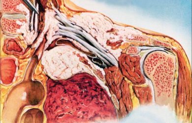 Pancoast tumor (introduction) early symptoms and signs of Pancoast tumor Pancoast tumor life expectancy Pancoast tumor survival rate Pancoast tumor symptoms stories Pancoast tumor histology Pancoast tumor diagnosis Pancoast tumor treatment