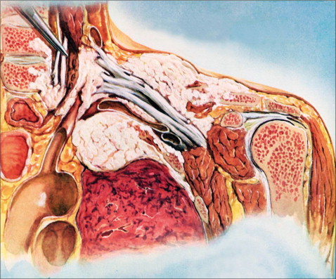 Pancoast tumor (introduction) early symptoms and signs of Pancoast tumor Pancoast tumor life expectancy Pancoast tumor survival rate Pancoast tumor symptoms stories Pancoast tumor histology Pancoast tumor diagnosis Pancoast tumor treatment