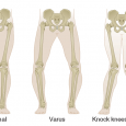 Valgus vs varus, knee, Elbow, Leg varus and valgus mnemonic?