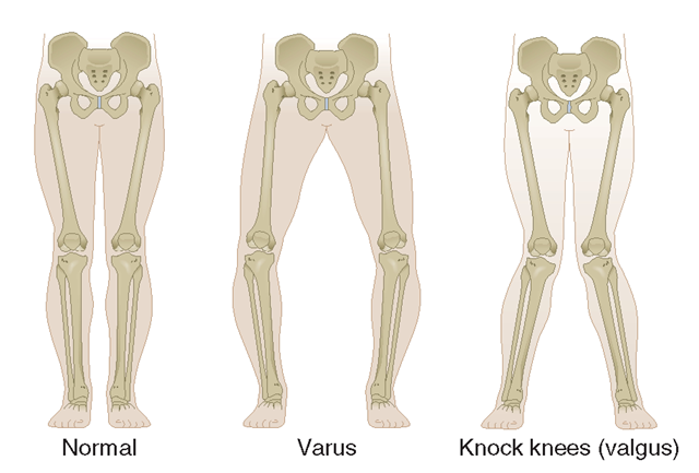 Valgus vs varus, knee, Elbow, Leg varus and valgus mnemonic?