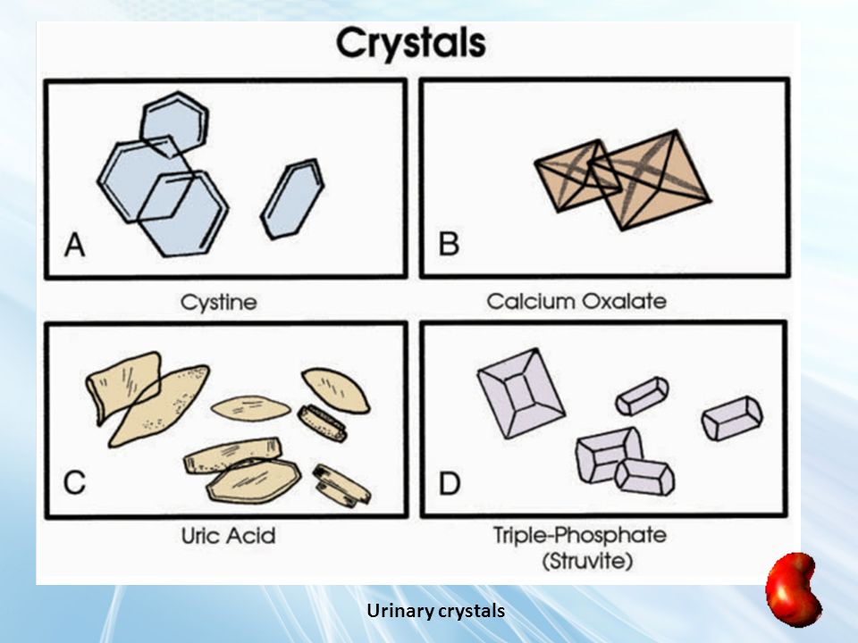 Urinary crystals, Crystals in urine symptoms, causes, treatment, diganosis, home remedies