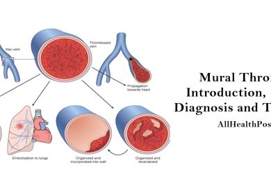 mural thrombus Introduction, Causes, Diagnosis, Treatment, Conclusion
