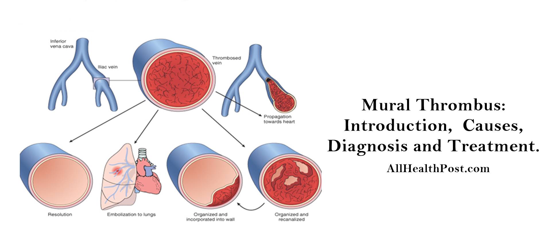 mural thrombus Introduction, Causes, Diagnosis, Treatment, Conclusion
