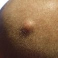 Sebaceous Cysts - What You Need to Know?