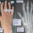 5 Ways to Detect Osteoarthritis