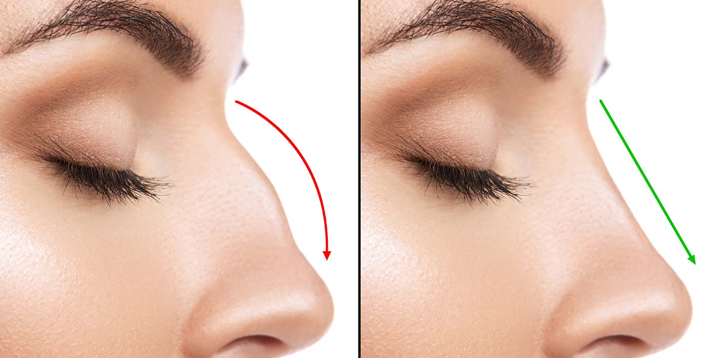 Benefits of Getting a Rhinoplasty and How to Choose the Right Service