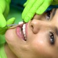 What Are Dental Veneers For? Read the Definition and Purpose