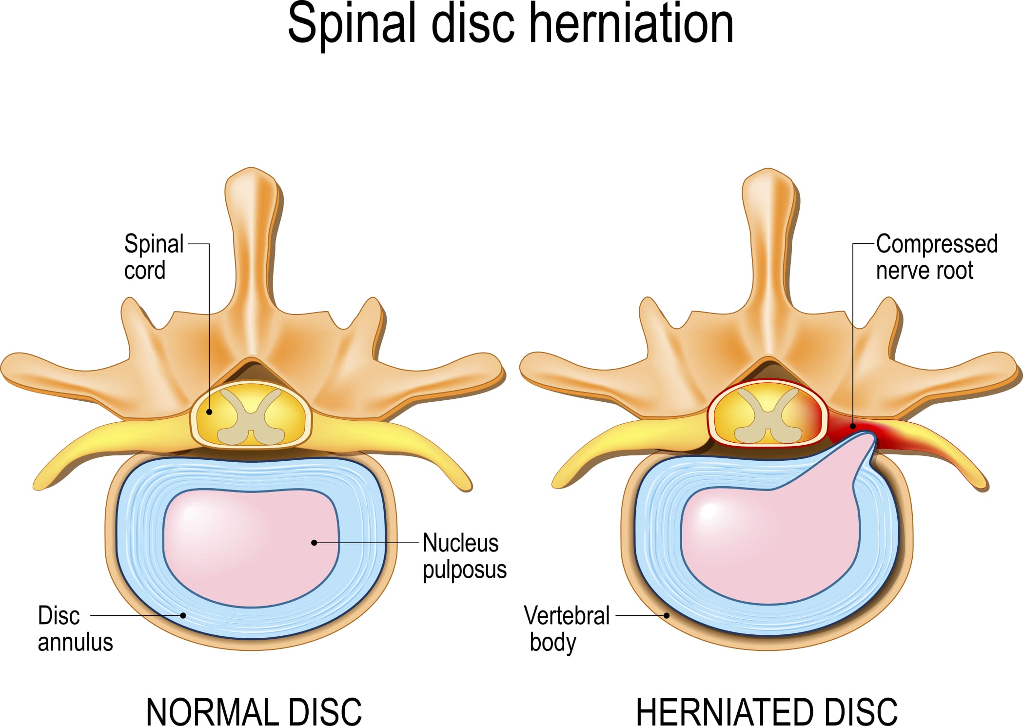 How to Prevent a Herniated Disc - Follow These Steps
