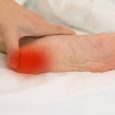 7 Natural Home Remedies for Heel Spurs to Relieve the Pain