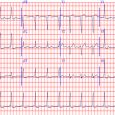 Everything You Need to Know about an Abnormal EKG