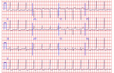Everything You Need to Know about an Abnormal EKG