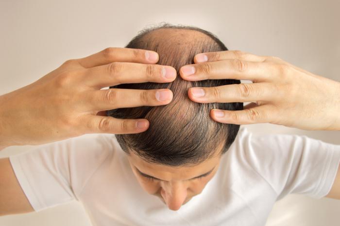 Hair Loss in Men: Here are Some Major Causes you Should Know